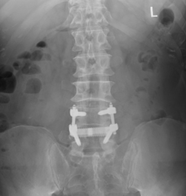 lumbar spine, back surgery, back pain, herniated disc, spine fusion, conservative care, chiropractic, back pain